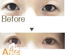 雙眼皮手術(shù) 雙眼皮手術(shù)