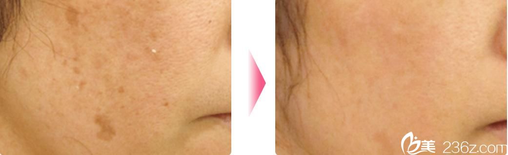 照射美肌 照射美肌