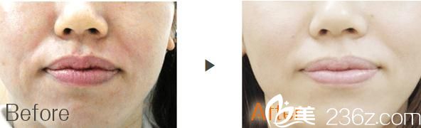 去法令紋 去法令紋