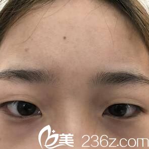 在沈陽割雙眼皮術前照 在沈陽割雙眼皮術前照