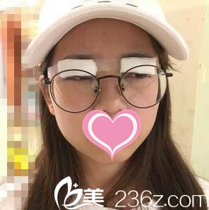 割雙眼皮術當天照 割雙眼皮術當天照