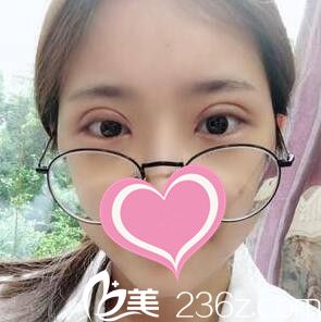 割雙眼皮術后第3天效果 割雙眼皮術后第3天效果