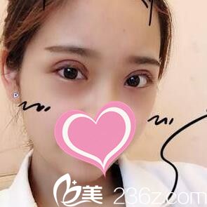 在沈陽安娜寶士麗割雙眼皮一周拆線 在沈陽安娜寶士麗割雙眼皮一周拆線