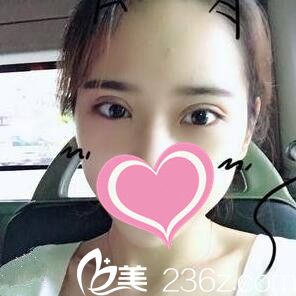 分享10月份我在沈陽(yáng)安娜寶士麗整形醫(yī)院割雙眼皮術(shù)后二十天恢復(fù)效果圖