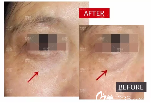 FOTONA歐洲之星4D無創(chuàng)溶脂祛眼袋案例