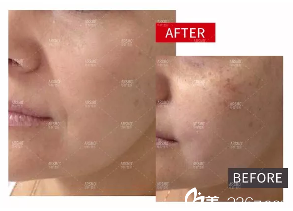 FOTONA歐洲之星4D鉺激光微米抗衰案例