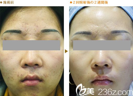 激光照射美肌 激光照射美肌