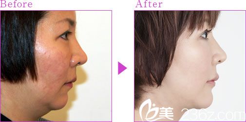 假體下巴 假體下巴