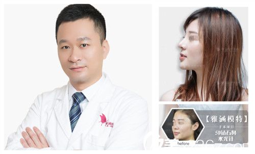 深圳雅涵整形高山院長隆鼻案例 深圳雅涵整形高山院長隆鼻案例