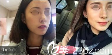 除皺對(duì)比案例圖