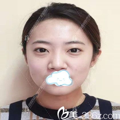 找沈陽百嘉麗汪曉蕾做雙眼皮開眼角術(shù)前照 找沈陽百嘉麗汪曉蕾做雙眼皮開眼角術(shù)前照