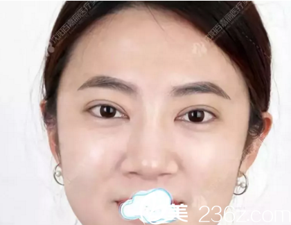 在沈陽百嘉麗做雙眼皮開眼角術(shù)后1個月效果 在沈陽百嘉麗做雙眼皮開眼角術(shù)后1個月效果