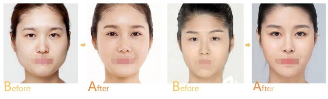 連云港大明雙眼皮<span style=