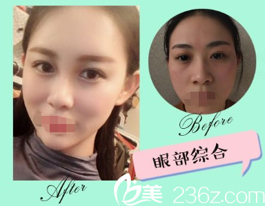 <!--<i data=20240703-sp></i>-->眼部綜合<span style=