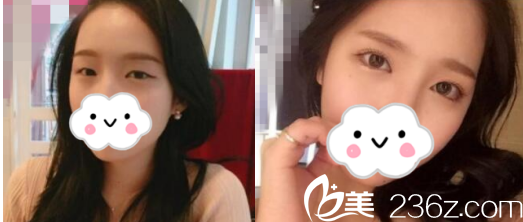 車建樺醫(yī)生全切雙眼皮<span style=