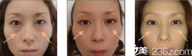 去眼袋手術(shù)