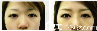 鼻尖形成術(shù)