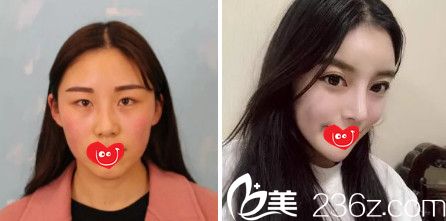 維多利亞張寶譽(yù)院長雙眼皮案例