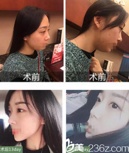 李成輝主任做肋軟骨隆鼻案例 李成輝主任做肋軟骨隆鼻案例