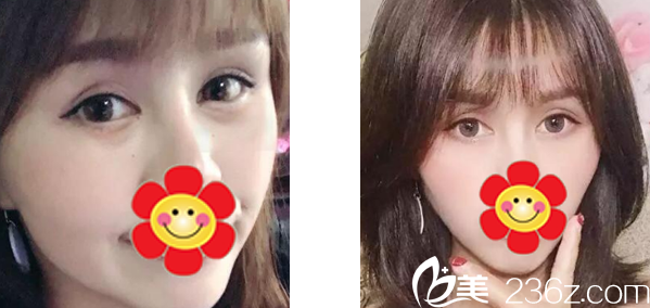 呼和浩特紫潔整形去眼袋<span style= 呼和浩特紫潔整形去眼袋<span style=