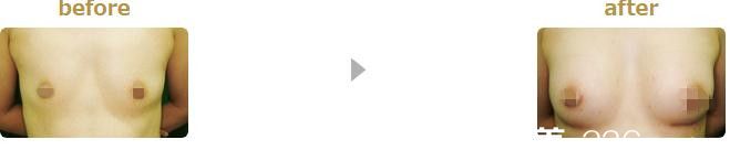 自體脂肪豐胸 自體脂肪豐胸