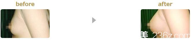 假體豐胸 假體豐胸