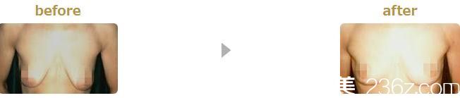 乳房下垂 乳房下垂