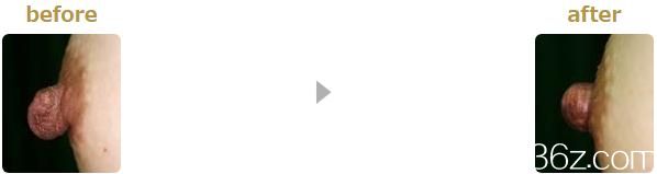 乳頭縮小術(shù) 乳頭縮小術(shù)