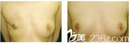 20181116_1542336985618817.jpg 乳房再建_副本.jpg