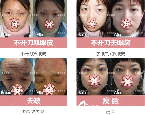 成都健麗雙眼皮去眼袋<span style=