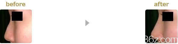 鼻尖形成 鼻尖形成