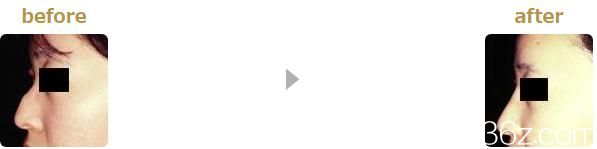 駝峰鼻修正 駝峰鼻修正