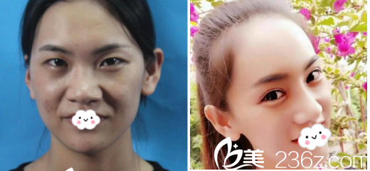 朱建瑩醫(yī)生眼部整形案例 朱建瑩醫(yī)生眼部整形案例