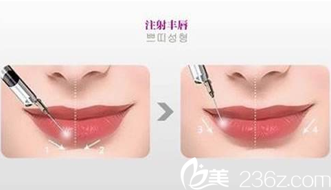 沈陽百嘉麗做的玻尿酸豐唇手術是否安全？要注意什么？