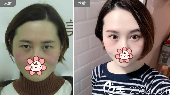 成都健麗葛振國雙眼皮案例 成都健麗葛振國雙眼皮案例