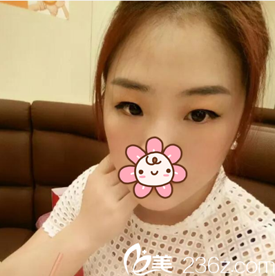 做雙眼皮術(shù)前照片 做雙眼皮術(shù)前照片