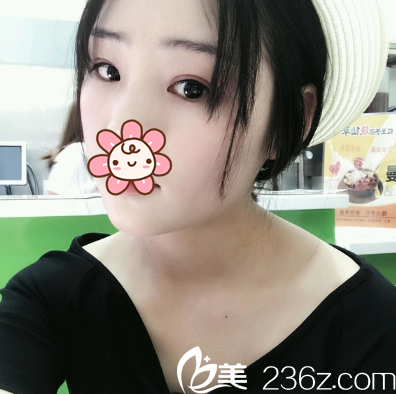 鐳射定點(diǎn)定位雙眼皮術(shù)后5天 鐳射定點(diǎn)定位雙眼皮術(shù)后5天