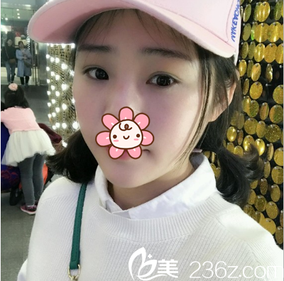 成都健麗雙眼皮術(shù)后半個(gè)月 成都健麗雙眼皮術(shù)后半個(gè)月