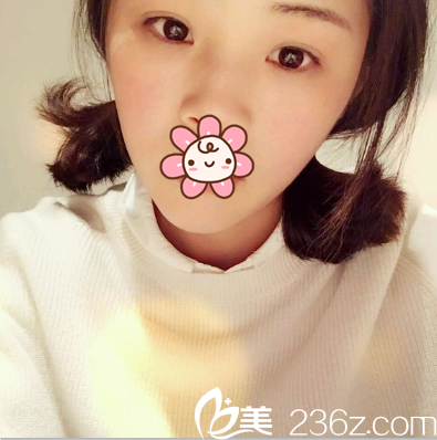 趙波濤定點(diǎn)雙眼皮術(shù)后一個(gè)月 趙波濤定點(diǎn)雙眼皮術(shù)后一個(gè)月