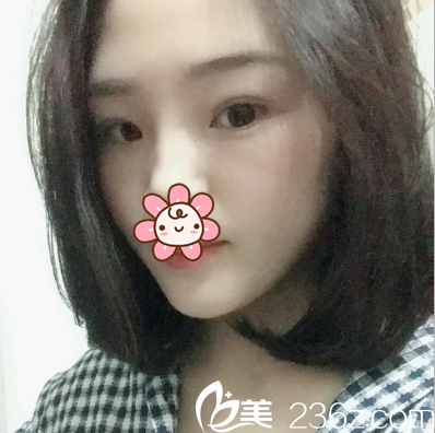 鐳射定點(diǎn)定位雙眼皮術(shù)后2個(gè)月 鐳射定點(diǎn)定位雙眼皮術(shù)后2個(gè)月