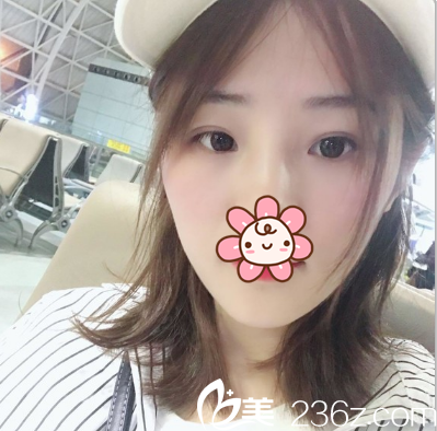 來一發(fā)成都健麗趙波濤鐳射定點定位雙眼皮術后反饋 恢復無切口