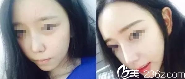 隆鼻效果圖對比