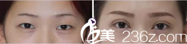 淮北東方美萊塢雙眼皮案例