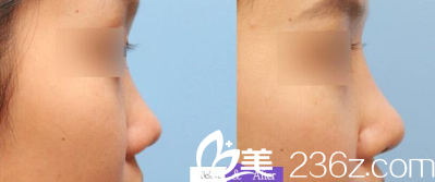 淮北東方美萊塢隆鼻案例