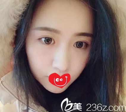 肋軟骨隆鼻7天拆線后鼻子微腫 肋軟骨隆鼻7天拆線后鼻子微腫