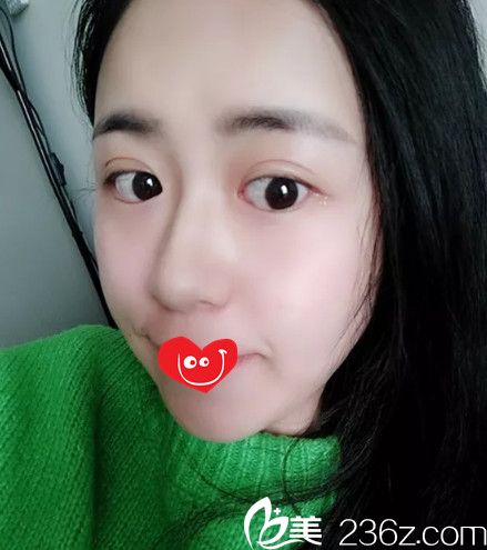 肋軟骨隆鼻23天鼻子消腫很多 肋軟骨隆鼻23天鼻子消腫很多