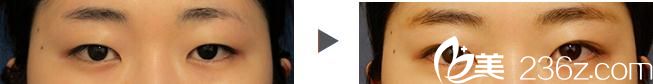 埋線雙眼皮