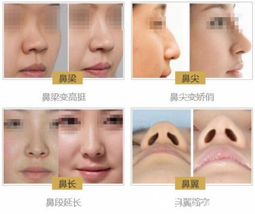 劉英醫(yī)生線雕隆鼻案例