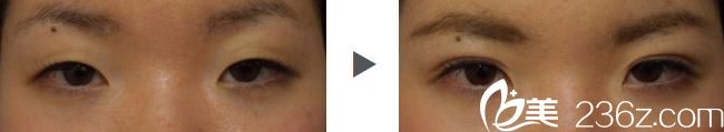 埋線雙眼皮展示