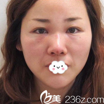 東營藝美李琳假體隆鼻真人案例